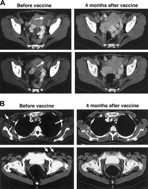 Fig. 6. Regression of tumors after booster vaccination with Id-KLH + chemical adjuvant. / Patient D12 was given Id-pulsed DC vaccination during first remission after chemotherapy but relapsed 15 months later. Subsequent to the development of widespread disease 18 months later, she was given injections of Id-KLH protein plus a chemical adjuvant. (A) CT images of the pelvis show that bulky left-sided pelvic lymph nodes have completely regressed 4 months after booster vaccinations. (B) Regression of axillary (top panels) and inguinal (bottom panels) lymph nodes after booster vaccinations. Arrows indicate sites of disease before vaccination.