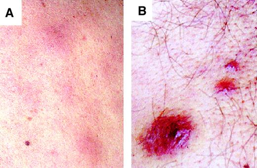 Fig. 1. Clinical appearance of skin lesions from 2 patients. / Obvious multiple cutaneous nodular erythematous purple lesions are seen. (A) Patient 10. (B) Patient 6. Magnification, × 1.