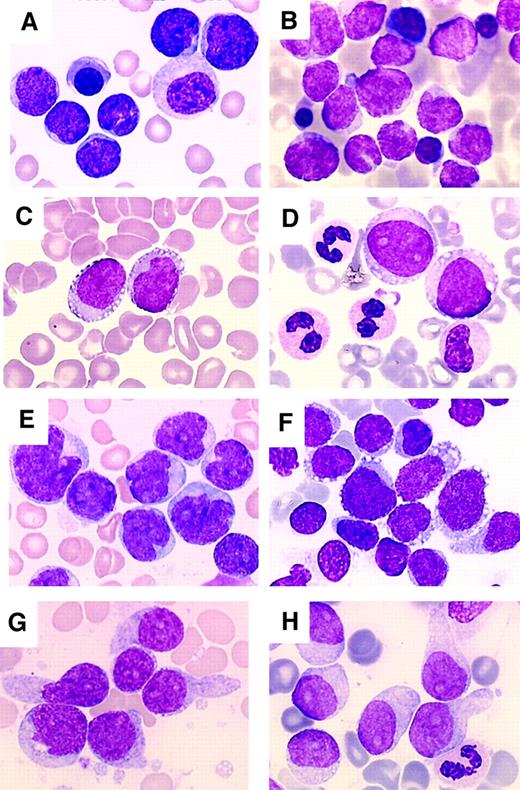 Fig. 2. Morphologic aspects of CD4+CD56+ tumor cells. / May-Grunwald staining of bone marrow smears. (A) Patient 1. (B) Patient 2. (C) Patient 8. (D) Patient 4. (E) Patient 12. (F) Patient 9. (G) Patient 17. (H) Patient 10. CD4+CD56+ tumor cells may correspond to small cells with a nucleus of a regular shape, a lacy chromatin, and a high nucleus/cytoplasm ratio (A and B). Cells may be larger with still a lacy chromatin and with a regularly shaped (C and D) irregular or indented (E) nucleus. The chromatin often presents a typical blastic appearance (F-H). Nucleoli are often clearly visible (A, C-E, G, and H). The size of blast cells may be heterogeneous (E and F). Tumor cells often display cytoplasmic vacuolation arranged as a pearl necklace along the cytoplasmic outline (C and D) or forming microvacuoles giving a heterogeneous aspect to the cytoplasm (F-H). Pseudopodialike membrane expansions are also frequent (F-H). Dysplastic features may be noted (A and D). Magnification, × 1000.