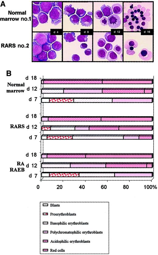 Fig. 3. Morphologic analysis. / Cytospin samples were prepared every 3 days and stained with May-Grünwald-Giemsa stain. (A) Cultured cells from normal bone marrow sample 1 and from RARS sample 2. Original magnification, × 100. (B) Erythroid subpopulations after various times in culture. Results are representative of the sequential analysis of cytospin samples prepared from 3 normal, 3 RARS, and 5 RA/RAEB samples.