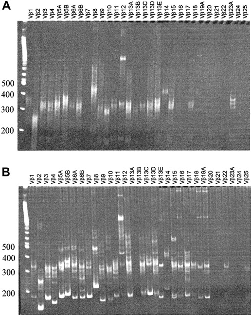 Fig. 4. Vβ-Cβ RT-PCR heteroduplex analysis of thymus and bone marrow. / RNA was isolated from thymus (sorted CD45+CD3+CD27+CD69+fraction) (A) and bone marrow (total, unsorted) (B), and after reverse transcription cDNA was amplified with PCR. On heteroduplex analysis of the thymus, polyclonal smears can be observed for most Vβ families. Bone marrow shows a pauciclonal pattern superimposed on polyclonal background smears.