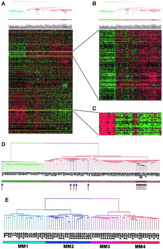 Fig. 1. Two-dimensional hierarchical cluster analysis of experimental expression profiles and gene behavior. / (A) Cluster-ordered data table. The clustering is presented graphically as a colored image. Along the vertical axis, the analyzed genes are arranged as ordered by the clustering algorithm. The genes with the most similar patterns of expression are placed adjacent to each other. Likewise, along the horizontal axis, experimental samples are arranged; those with the most similar patterns of expression across all genes are placed adjacent to each other. Both sample and gene groupings can be further described by following the solid lines (branches) that connect the individual components with the larger groups. The color of each cell in the tabular image represents the expression level of each gene, with red representing an expression greater than the mean, green representing an expression less than the mean, and the deeper color intensity representing a greater magnitude of deviation from the mean. (B) Amplified gene cluster showing genes down-regulated in MM. Most of the characterized and sequence-verified cDNA-encoded genes are known to be immunoglobulins. (C) Cluster enriched with genes whose expression level was correlated with tumorigenesis, cell cycle, and proliferation rate. Many of these genes were also statistically significantly up-regulated in MM (χ2 and WRS test) (Table 5). (D) Dendrogram of hierarchical cluster; 74 cases of newly diagnosed untreated MM, 5 MGUS, 8 MM cell lines, and 31 normal bone marrow PC samples clustered based on the correlation of 5483 genes (probe sets). Different-colored branches represent normal PC (green), MGUS (blue arrow), MM (tan), and MM cell lines (brown arrow). (E) Dendrogram of a hierarchical cluster analysis of 74 cases of newly diagnosed untreated MM alone (clustergram not shown). Two major branches contained 2 distinct cluster groups. The subgroups under the right branch, designated MM1 (light blue) and MM2 (blue) were more related to the MGUS cases in Figure 1D. The 2 subgroups under the left branch, designated MM3 (violet) and MM4 (red) represent samples that were more related to the MM cell lines in Figure 1D.