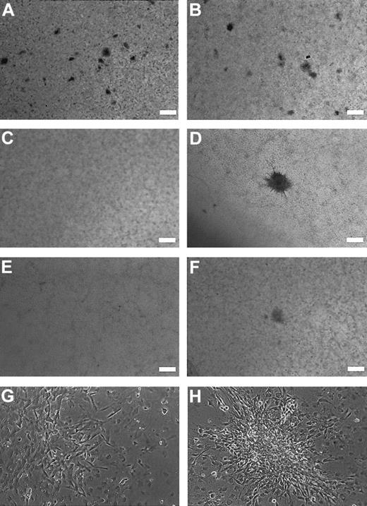 Fig. 3. Focus formation assay illustrating the oncogenic potential of. / GSH2. Monolayer of cells overexpressing wild-typeGSH2 (A,B: 2 different frames of the same dish), indicating a high number (> 200 foci/10 cm dish) of relatively small foci, compared with the monolayer of cells transduced with the empty MSCV vector (C). In the latter case, spontanous foci (0-10 foci/10 cm dish) were observed. Typically, these foci were relatively larger than the foci observed with GSH2 overexpression (compare panels A and B with D). The N-terminal deletion mutant and homeobox deletion mutant of GSH2 induced only a low number of foci, similar to the empty vector. The monolayers observed with these construct are shown in panels E and F. (A-F: scale bar = 2 mm). The morphology and size of the foci observed for these constructs were similar to the foci observed for the empty vector. Although the cells overexpressingGSH2 generated relatively small foci, higher-magnification pictures (G,H) clearly show the presence of transformed cells growing on top of the monolayer.