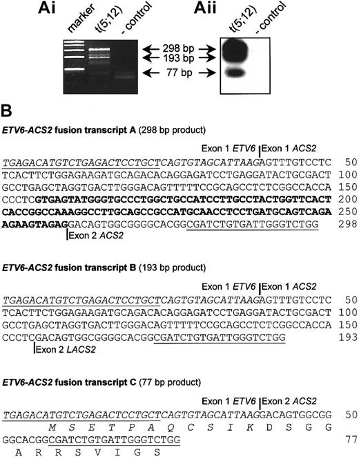 Fig. 4. Detection of. / ETV6-ACS2 fusion transcripts in the aCML case with a t(5;12)(q31;p13) (case 7). (Ai) RT-PCR confirmed the fusion of ETV6 to ACS2, as identified by 3′-RACE in the t(5;12) case (case 7). (Aii) Hybridization with an internal oligonucleotide revealed the existence of 3 different fusion transcripts, which was confirmed by cloning and sequencing of these RT-PCR products, shown in the lower panel. (B) Representation of the identified fusion transcripts. Open reading frames were determined on the basis of the start codon of ETV6. Only transcript C is an in-frame fusion. Exon numbering of ACS2 is according to Yagasaki et al.22