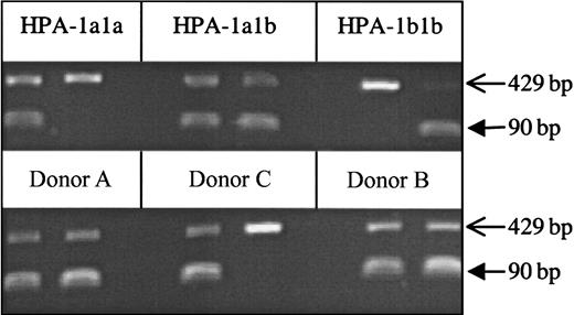 Fig. 2. Genotype of Donor A by PCR-SSP. / Genomic DNA samples from Donor A, his mother (Donor C), and his son (Donor B) were HPA-1 genotyped by PCR-SSP. The 3 control samples (HPA-1a1a, 1a1b, and 1b1b) show the expected amplicons of 90 bp for HPA-1 (filled arrows) and control amplicons obtained with primers specific for human growth hormone (429 bp; open arrows). The PCR-SSP genotypes of the test samples are HPA-1a1b, HPA-1a1a, and HPA-1a1b for Donor A, Donor C, and Donor B, respectively.