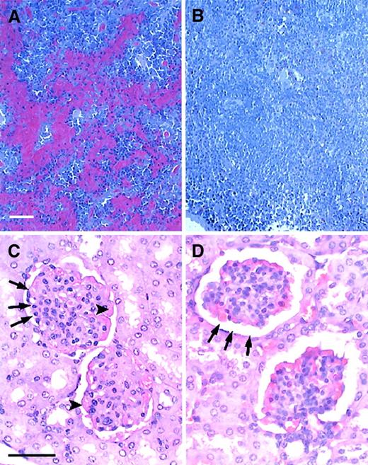 Fig. 9. Engrafted mice showed no evidence of characteristic sickle splenic and renal pathology. / (A,B) Histology of the spleen in untreated and engrafted mice. (A) Untreated sickle spleen. Splenic architecture is highly abnormal with pooling of sickled RBCs and areas of increased hematopoiesis. (B) Spleen from an engrafted mouse killed 5 months after transplantation. Splenic architecture is now normal. No RBC pooling is present. (C,D) Histology of the kidney in untreated and engrafted mice. (C) Untreated sickle kidney. The sickle kidney shows evidence of membranoproliferative glomerulonephritis. Arrowheads point to thickened glomerular membrane. Arrows point to narrowed glomerular space. (C) Kidney from an engrafted mouse killed 5 months after transplantation. Glomerular architecture is now normal. Sickle mice were age-matched to engrafted mice for this analysis. Sections were stained with hematoxylin and eosin. Bars = 50 μm.