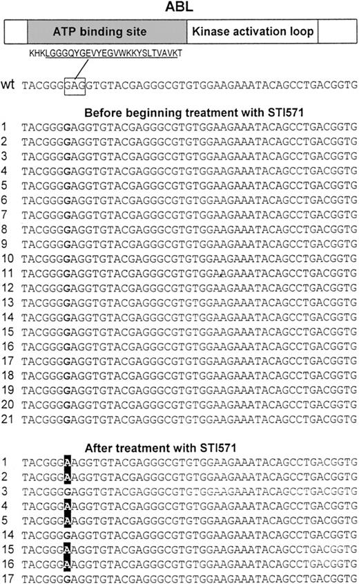 Fig. 1. Point mutations at the ATP-binding site of the ABL kinase. / A 714-bp region of ABL that codes for the ATP-binding site and the kinase activation loop was PCR amplified using 2 primer pairs and directly sequenced in 30 complementary DNAs (including 9 paired samples) obtained from the bone marrow of individuals with Ph+ ALL. Sequencing revealed a single point mutation at nucleotide 1127 (GI6382056) changing a G to an A resulting in Glu255Lys. This mutation was found in 6 samples from patients who where treated with STI571 (nos. 1, 2, 4, 5, 15, 16) but not in any other sample including paired samples from the same individuals before treatment with STI571. (Top) Schematic protein structure of ABL including the amino acid sequence for the highly conserved ATP-binding site motif (underlined). The nucleotide sequence corresponding to Glu255, which is affected by the mutation is marked by a rectangle. The left hand column contains the patient number; wt indicates wild-type ABL.