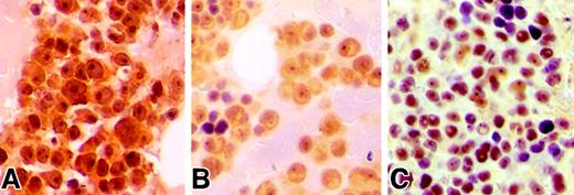 Fig. 1. Immunohistochemical analysis of pS473-AKT in MM patients. / (A-C) Bone marrow biopsies obtained from MM patients demonstrate immunopositivity for pSer473-AKT in plasma cells. Biopsies were fixed in 10% zinc formalin for 2 hours, subsequently decalcified in Decalcifier II (Surgipath Medical Industries, Richmond, IL) for 2 hours and processed by a standard automated processor. Four μM sections mounted on glass slides underwent microwave antigen retrieval process in citrate buffer, subsequently incubated with anti–pSer473-AKT antibody at 1/100 dilution overnight at 4°C similar to described previously.9 Slides were then stained with a streptavidin/peroxidase detection system.9 Note that panels A and C illustrate prominent nuclear and nucleolar staining in the neoplastic plasma cells. Magnification × 500.