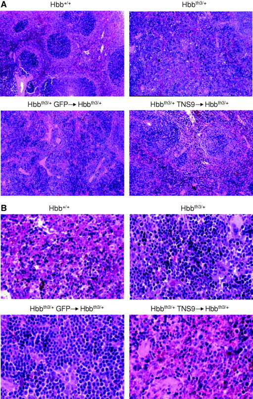 Fig. 3. Amelioration of splenic architecture and erythropoiesis in TNS9-treated chimeras. / (A) Upper left: spleens from the normal control mice showed distinct red and white pulp areas. Upper right: spleens from the Hbbth3/+ control mice showed marked expansion of the red pulp. Lower left: spleens from mice that received transplants of control eGFP-transduced Hbbth3/+ bone marrow showed marked expansion of the red pulp. Lower right: spleens of Hbbth3/+ mice that received transplants of Hbbth3/+ bone marrow treated with TNS9 showed less expansion of the red pulp and were morphologically intermediate between those of the normal and Hbbth3/+ control mice. Table 1presents a complete analysis. Chimeras and control mice were age-matched. Original magnification × 22. (B) Upper left: red pulp from the normal control mice contained only a small number of nucleated erythroid cells. Upper right: red pulp of Hbbth3/+ control mice was almost entirely composed of nucleated erythroid precursors packing the cords and compressing the sinuses. The latter contained anucleated cells, but in reduced proportions (here, about 10%-20% of the red pulp), along with a significant number of megakaryocytes and some myeloid precursors. Lower left: red pulp of mice that received transplants of control eGFP-transduced Hbbth3/+ bone marrow showed a similar amount of EMH as the Hbbth3/+ control mice. Lower right: the splenic red pulp of the Hbbth3/+mice that received transplants of TNS9-treated Hbbth3/+bone marrow contained significantly fewer nucleated erythrocytes (here, about 20% of the red pulp), indicating a decreased amount of EMH compared to both Hbbth3/+ control mice and mice that received transplants of eGFP-transduced Hbbth3/+ bone marrow. Original magnification × 132.