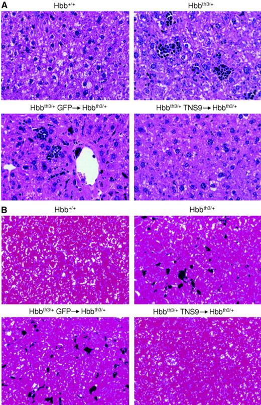 Fig. 4. Correction of liver pathology in TNS9-treated chimeras. / (A) Upper left: livers from Hbb+/+ control mice showed no evidence of EMH. Upper right: livers from Hbbth3/+ control mice showed a significant amount of EMH as evidenced by the presence of erythroid precursors in the sinusoids. Lower left: livers from Hbbth3/+ mice that received transplants of eGFP-transduced Hbbth3/+ bone marrow showed evidence of EMH. Lower right: similar to the normal control livers, the Hbbth3/+ mice that received transplants of TNS9-treated Hbbth3/+ bone marrow showed no evidence of EMH. Original magnification × 88. (B) Upper left: no iron was identified in the livers of Hbb+/+control mice. Upper right: a moderate amount of iron was seen in livers from Hbbth3/+ control mice. Lower left: a large amount of iron was seen in the livers of Hbbth3/+ mice that received transplants of eGFP-treated Hbbth3/+ bone marrow. Lower right: iron was only rarely identified in the Hbbth3/+mouse that received a transplant of TNS9-treated Hbbth3/+bone marrow cells. Original magnification × 88.