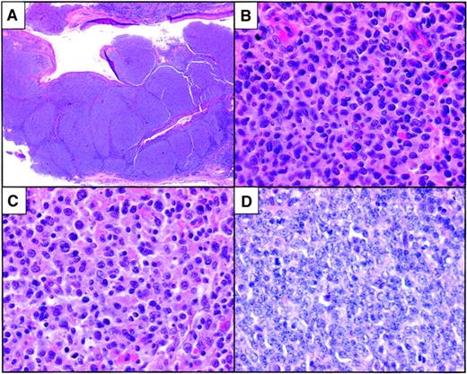 Fig. 1. Histopathological features of pediatric follicular lymphoma. / (A) Low-grade tumor with large, focally coalescent nodular architecture. (B) Higher-power magnification of a case with predominantly intermediate-grade cytologic features. A grade 3 diffuse component was focally present in the tumor. (C) One case with floral variant morphology was composed predominantly of centroblasts, some of which had cleaved-cell morphology. (D) High-grade tumor with brisk mitotic rate and frequent apoptotic cells. Original magnification A, × 10; B-D, × 400. All images were stained with hematoxylin and eosin.