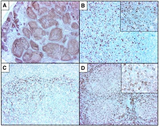 Fig. 2. Immunophenotypic features of pediatric follicular lymphoma. / (A) Immunohistochemistry for CD20 highlights the follicular architecture of this tumor. (B) The neoplastic cells of nearly all cases were positive for bcl-6. (C) Most of the cases manifested expanded networks of follicular dendritic cells as highlighted in this immunostain for CD21. (D) Immunostaining for bcl-2 reveals moderately intense expression of bcl-2 by neoplastic lymphoma cells within the nodules. Original magnification A, × 10; B, × 200; C-D, × 100; insets, × 400.