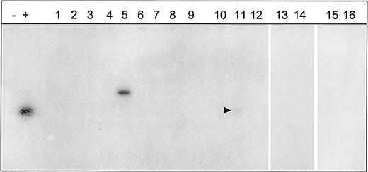 Fig. 3. PCR to detect t(14;18) at the mbr. / PCR was performed as described in “Materials and methods” and subsequently subjected to Southern analysis by means of a radiolabeled internal oligonucleotide probe. − indicates negative water control; +, positive control. Lanes 1 through 16 are pediatric follicular lymphoma cases. A faint band was present in lane 11; this was confirmed on longer exposure of the autoradiogram. The lane numbers correspond directly to the patient and case numbers in Tables 1 and 2.