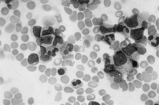 Fig. 1. Bone marrow appearance on admission. / Marked decrease of nucleated erythroid cells with binucleate erythroblasts, absence of megakaryocyte, and normal myeloid cells. Magnification, × 1000.