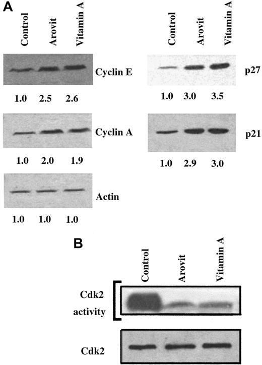 Fig. 4. Analysis of the cell cycle in vitamin A– and Arovit-treated MSCs. / (A) Cyclin E, cyclin A, p27Kip1, p21Cip1, and actin immunoblotting analyses of 48 hours of vitamin A–treated MSCs. The concentration of all-trans-retinol used in the experiment was 40 μM. Protein (20 μg) was used for actin, cyclin, and p27Kip1immunoblotting, whereas 80 μg protein was used for p21Cip1. At the bottom of each immunoblot the relative amount of the signals (control is assumed as 1.0) determined by laser scanning. (B) Cdk2 was immunoprecipitated from equal amounts of cellular extracts (500 μg) as reported in “Patient, materials, and methods.” Identical aliquots of the immunoprecipitated materials were assayed for the kinase activity (Cdk2 activity) and for the cdk2 total contents by immunoblotting (Cdk2).