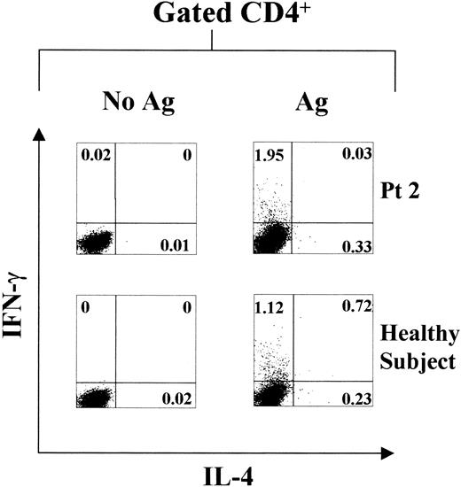 Fig. 3. HBenvAg-specific intracellular cytokine production. / HBenvAg-stimulated or unstimulated PBMCs obtained from 1 representative XLA patient (patient 2) and 1 control subject and assayed by flow cytometry, are shown. Analysis was performed 24 months after the last anti-HBV vaccine boost. PBMCs were cultured with 10 μg/mL HBenvAg for 18 hours at 37°C, 5% CO2; at 2 hours after cultures were started, brefeldin-A was added. Fixed and permeabilized cells were triple stained with anti-CD4, anti–IFN-γ, and anti–IL-4 as described in “Patients, materials, and methods.” Cells were gated according to CD4 expression, and data are represented as IL-4–producing cells on the x-axis and IFN-γ–producing cells on the y-axis. The percentage of either single- or double-positive cells is indicated in the respective plot quadrants. Pt indicates patient.