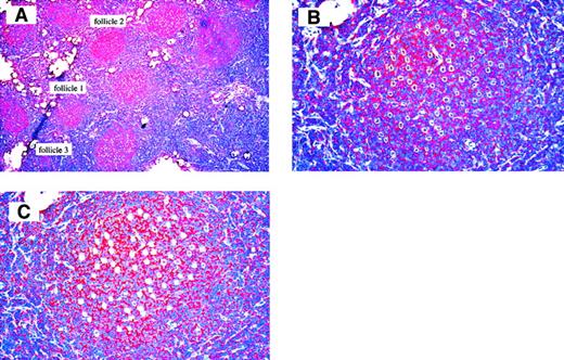 Fig. 1. Frozen section of case 3 used for micromanipulation. / Anti-CD20 antibody staining, hematoxylin counterstain. (A) 150 FL B cells from 3 different follicles were micromanipulated (50 cells per follicle), 50 × magnification. (B) Follicle 1 after dissection from surrounding tissue with UV laser beam, 200 × magnification, and (C) after aspirating the cells with micropipettes, 200 × magnification.