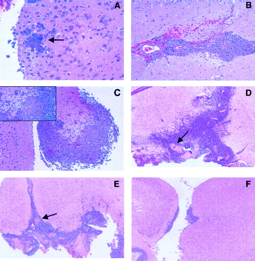 Fig. 1. Growth characteristics of intracerebral L5178Y lymphoma cells. / (A-F) Histologic section stained with hematoxylin-eosin. (A-C) Tumor cell growth in untreated animals. (A) Section obtained from mice killed 2 days after tumor challenge, demonstrates early neoplastic infiltration of the brain. Arrow points to lymphoma cells surrounding a capillary vessel (original magnification, 40 ×). (B) Extensive infiltration, associated with small hemorrhages, is observed in mice killed 4 days after challenge (original magnification, 25 ×). (C) Massive neoplastic infiltration, with brain damage (inset), is detected in mice killed 6 days after challenge (original magnification, 10 ×, inset 40 ×). (D-F) Effects of drug treatment on tumor cell growth. Histologic analysis of untreated or drug-treated mice was performed on day 15 after tumor challenge in additional mice that were not considered for the evaluation of survival (original magnification, 4 ×). Arrows point to hemorrhage and necrosis. (D) Untreated control: massive neoplastic infiltration of the brain. (E) 100 mg/kg TZM on days 2 and 3: diffuse brain infiltration. (F) 100 mg/kg NU1025 + TZM on days 2 and 3: focal collections of neoplastic cells, localized mostly under the leptomeninges, with initial infiltration of the brain tissue. There is no evidence of hemorrhage or necrosis. Tumor cell growth was analyzed by quantitative morphometry of histologic sections (n = 15, 5 animals/group). Results, expressed as mean area (mm2± SE) of tumor infiltration, were as follows: untreated control, 6.82 ± 2; TZM, 5.52 ± 1; NU1025 + TZM, 0.058 ± 0.05. Statistical analysis according to unpaired Student's ttest: NU1025 + TZM versus untreated controls,P = .00104; NU1025 + TZM versus TZM,P = .000108; TZM versus untreated controls,P = .115. Tumor growth inhibition induced by NU1025 + TZM or by TZM was 99% (range, 98%-99.9%) and 20% (range, 12%-49%), respectively.