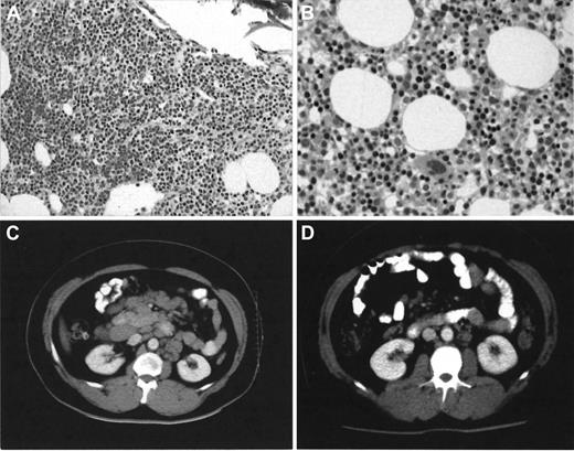 Fig. 1. Bone marrow trephine and CT scan appearances in patient UPN3 before and after combined Campath-1H and fludarabine therapy. / Note heavy infiltrate (A) × 10 by small lymphocytes observed after 16 weeks of single-agent Campath-1H has completely cleared (B) × 20 with normal erythropoiesis evident after combined Campath-1H and fludarabine. Stained with hematoxylin-eosin. The CT scan (D) shows almost complete radiologic resolution of his previously massive lymphadenopathy (C).