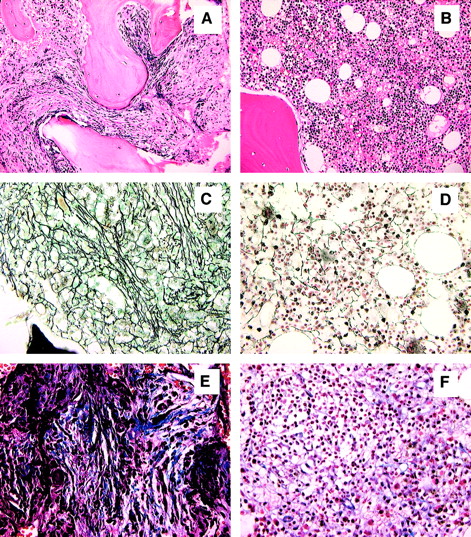 Fig. 1. Normalization of bone marrow morphology following reduced-intensity conditioning. / Hematoxylin and eosin stain of bone marrow prior to transplantation (A) and 11 months after transplantation (B). Reticulin stain of bone marrow prior to transplantation (C) and 11 months after transplantation (D). Masson-trichrome stain prior to transplantation (E) and 11 months after transplantation (F). Figures are from patient 4 and are representative of results observed in each patient. All magnifications are × 20.
