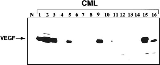 Fig. 1. Representative Western blot showing VEGF protein expression in samples from patients with CML. / Western blot includes 1 sample from a normal control (N) donor and 16 CML patient samples.