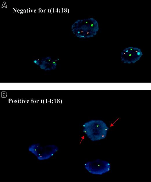 Fig. 1. Detection of the t(14;18) by interphase FISH. / (A) The t(14;18)-negative cells show one hybridization signal in the IgH region on each chromosome 14 (green), each BCL2 region on chromosome 18 (red), and the centromere of chromosome 18 (aqua). (B) The t(14;18)-positive cells show 2 abnormal yellow fusion signals.