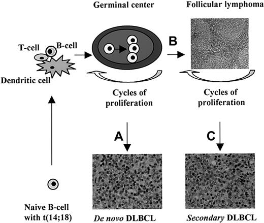 Fig. 5. Concept of the cellular origin of t(14;18)-positive DLBCL. / The t(14;18) occurs as a rare random event in naive B cells, probably during the D/J rearrangement of the IGH gene. Such a B cell may encounter the appropriate antigen in the context of dendritic cells and T cells in the paracortical region of a lymph node. The stimulated B cell then migrates to and proliferates in a GC. Overexpression of bcl-2 protein protects the cell and its progeny from apoptosis even when the affinity of the antibody is not very high. Repeated cycles of proliferation from subsequent antigenic encounters expand this clone and result in additional genetic abnormalities. Different secondary genetic alterations lead to the development of a primary DLBCL (A) or a follicular lymphoma (B). Further genetic changes occurring during the course of a follicular lymphoma will give rise to a secondary DLBCL in some cases (C). A number of genes may be able to initiate each of these pathways and the gene expression profile may be unique and distinguishable for each.