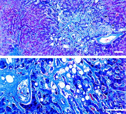 Fig. 1. Trichrome-stained sections of necropsied liver. / The patient died of multiorgan failure 37 days after receiving the first of 2 doses of Mylotarg (6 mg/m2). Standard bar equals 100 μm. (upper panel) Extensive sinusoidal fibrosis adjacent to a nonoccluded sublobular venule. (lower panel) Zone 3 region containing atrophic hepatocyte cords surrounded by markedly widened sinusoids filled with dense collagen. An adjacent central venule shows eccentric perivenular fibrosis.