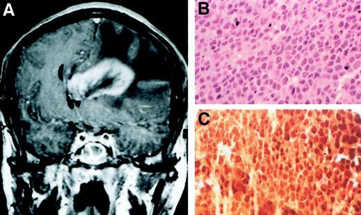 Fig. 2. Primary cerebral lymphoma 23 months after MCD diagnosis in patient 5. / (A) Cerebral CT scan; (B) large cell NHL; (C) positive staining with the KSHV/HHV8 LNA-1 specific monoclonal antibody. Original magnification ×400 in panels B and C.