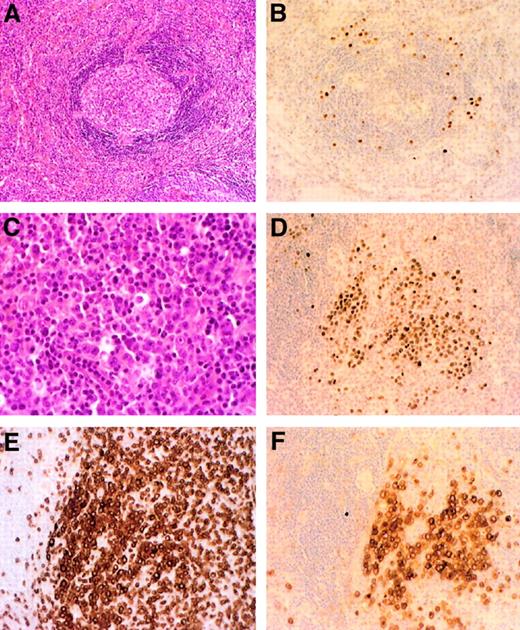 Fig. 3. Systemic NHL 18 months after MCD diagnosis in patient 7. / Initial lymph node biopsy shows the typical Castleman lesion (A) and the positive staining with the KSHV/HHV8 LNA-1 specific monoclonal antibody (B). Postmortem spleen analysis reveals diffuse infiltration with large/anaplastic cells (C), with positive staining with the KSHV/HHV8 LNA-1 antibody (D), an illegitimate expression of the T-cell CD3 marker (E), and the expression of the CD30 marker (F). Original magnification ×200 in panels A, B, D-F; ×400 in C.