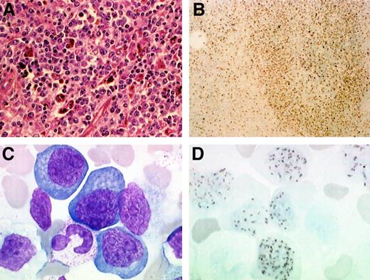 Fig. 4. Plasmablastic lymphoma complicating HIV-associated MCD in patients 12 and 14. / In patient 14, spleen analysis (A) shows a diffuse infiltration with plasmablastic cells, which stained positive with a KSHV/HHV8 specific LNA-1 monoclonal antibody (B). In patient 12, a blood smear (C) shows leukemic plasmablastic cells and nuclear staining of the circulating plasmablastic cells with a KSHV/HHV8 specific LNA-1 monoclonal antibody (D). Original magnification ×400 in panel A; ×100 in panel B; and ×2400 in panels C and D.