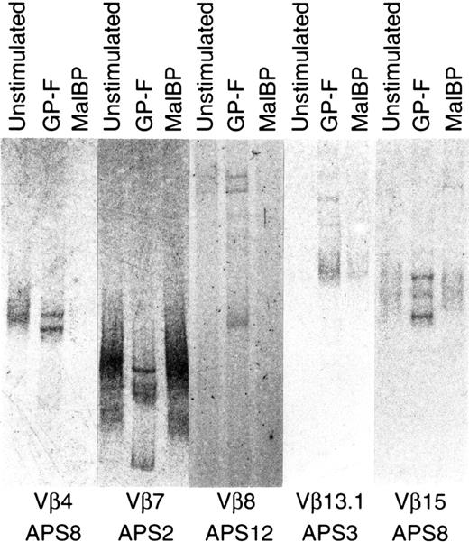 Fig. 1. Oligoclonal expansion of TCRβ after stimulation with β2GPI. / PCR-amplified TCRβ products of unstimulated, GP-F–stimulated, and MalBP-stimulated T cells were fractionated on 5% polyacrylamide–glycerol gels and stained with silver. Oligoclonally expanded single-strand DNA bands present in GP-F–stimulated T cells, but not in unstimulated or MalBP-stimulated T cells, were identified as DNAs encoding TCRβ chains of β2GPI-reactive T cells.