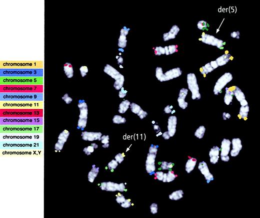Fig. 1. Identification of a cryptic t(5;11) using the M-TEL assay. / Color classification (goldFISH)2728 analysis of a bone marrow metaphase from patient 3, hybridized with the M-TEL1 probes. Chromosomes 1, 3, 7, 9, 13, 15, 17, 19, 21, and X and Y probes were all correctly hybridized. However, one homologue of chromosome 5 has chromosome 11 material on the q arm (yellow), and the corresponding chromosome 11 homologue has chromosome 5 material on the p arm (green). This corresponds to a balanced translocation, t(5q;11p). The der(5) and der(11) are indicated by arrows.