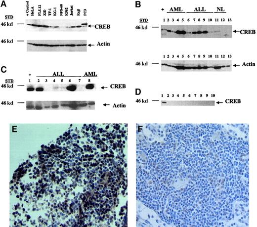 Fig. 1. Expression of CREB in leukemia cell lines and bone marrow samples from patients with acute leukemia. / Shown are results of Western blot analyses of cell lines and of bone marrow specimens from patients with and without leukemia. (A) Leukemia and nonleukemia cell lines were assessed for CREB expression by Western blot analysis. Cells were grown to a density of 1 × 106 cells/mL, and lysates were prepared from 1 × 106 cells. Twenty micrograms of protein from cell lysates was loaded on a 10% sodium dodecyl sulfate (SDS)–polyacrylamide gel. Blots were probed with anti-CREB antiserum (0.5 μg/mL), stripped, and reprobed with actin (60 μg/mL) as the loading control. The arrows represent CREB (43 kd) or the actin control (43 kd). (B) Mononuclear cells from bone marrow obtained from patients with leukemia or without active disease were processed with the Ficoll-Hypaque method. Lysates were prepared from 1 × 106 mononuclear cells. Twenty micrograms of protein was loaded on a 10% SDS-polyacrylamide gel. Western blot analysis was done with anti-CREB antiserum. Shown are results with positive controls (32Dcl3 cell lysates; lane 1), results with the AML (lanes 2-5) and ALL (lanes 6-7) samples, and results with samples from patients without active leukemia or with normal bone marrow (lanes 11-13). (C) Western blot analysis of lysates from bone marrow from patients with ALL and AML at diagnosis (lanes 2, 5, and 8), remission (lanes 3 and 7), and relapse (lane 4); lanes 2-4 are results from the same patient with ALL at diagnosis, remission, and relapse, respectively. Lanes 6 and 7 are results from the same patient at diagnosis and remission, respectively. (D) Bone marrow from 9 patients without leukemia was obtained and isolated as described above. Lane 1 shows results with the positive (plus sign) control (32Dcl3 cell lysates). All lanes had equal protein loading on Ponceau S staining (data not shown). Densitometry measurements showed that the CREB-to-actin ratio ranged from 0.1 to 3.0 and the fold difference between leukemia and nonleukemia samples ranged from 3.5 fold to 10 fold. (E) Immunohistochemical analysis with CREB antiserum (10 μg/mL) was done on bone marrow biopsy specimens from (E) a representative patient with ALL and (F) a normal lymph node (× 40 magnification). Nuclear staining of CREB was observed in leukemia blast cells but not in normal lymphocytes. Staining was not detected with rabbit IgG (data not shown).