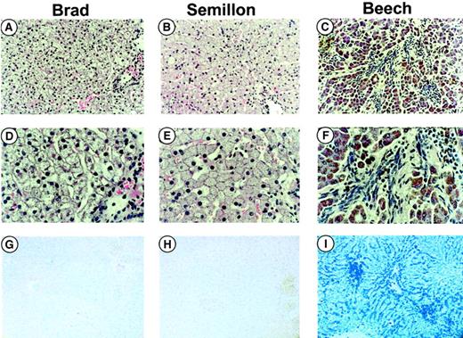 Fig. 3. Histologic examinations. / Histology of formalin-fixed liver sections from hemophilia B dogs (with FIX null mutation) Brad (A, D, G), Semillon (B, E, H), and Beech (C, F, I) treated with the AAV-(ApoE)4/hAAT-cFIX vector. The tissues were stained with hematoxylin and eosin (H&E, A-F) or Prussian blue (PB), a stain for detection of iron (G-I). Tissues from Brad and Semillon were taken by biopsy at week 27 and 32, respectively, and tissue from Beech was taken by necropsy at week 11. Beech had PK deficiency, a disease characterized by iron deposition in the liver as evident by the blue stain in panel I. Fibrosis (note fibrotic changes in panels C and F) is present in panels C and F but not in panels A, B, D, and E. Original magnification × 100 (A-C and G-I) or × 400 (D-F).