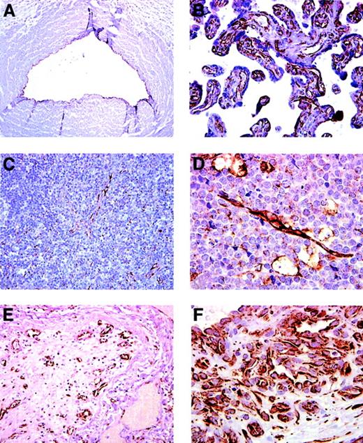Fig. 1. SDF-1 expression in endothelial cells lining capillary vessels revealed by immunohistochemical staining. / (A) Umbilical vein: the endothelium lining the vein stains positive for SDF-1. (B) Placenta: capillaries and blood vessels within chorionic villi are positive for SDF-1. (C) Lymph node: SDF-1 staining marks high endothelial venules within T-cell areas. Isolated cells identified morphologically as macrophages–dendritic cells are positive for SDF-1. (D) Lymph node: endothelium and scattered macrophages within Burkitt lymphoma stain positive for SDF-1. (E) Lung: a medium-size occluded vessel (within an area of organizing pneumonia) with evidence of recanalization displays SDF-1–positive endothelium lining the newly formed intraluminal vessels. (F) Skin: the typical lobular capillary network of a pyogenic granuloma (lobular capillary hemangioma) and small capillaries lined by prominent endothelial cells are positive for SDF-1. Original magnification, ×40.