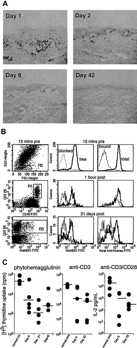 Fig. 2. Pharmacodynamics and T-cell mitogen responses after therapy with visilizumab. / (A) Skin biopsies from a representative patient with cutaneous GVHD documenting clearance of CD8+ dermal T-cell infiltrates (black dots) following a single dose of visilizumab on day 1. Original magnification × 100, immunoperoxidase staining. (B) Flow cytometric analysis of peripheral blood leukocytes from the same patient, before and after visilizumab. Details of antibody staining are described in “Patients and methods.” Lymphocytes were identified (left panels) by their characteristic forward and light scatter (R2). Thus set, the R2 gate contained more than 95% of the CD5 bright events in R1 (T cells). The right panels show T-cell surface CD3 molecules bound by visilizumab in vivo (dotted line) and total surface CD3 (solid line). The middle panels show free CD3 (solid line) or free CD3 blocked by exogenous visilizumab (dotted line). The relative amounts of free, bound, and total CD3 before and after administration of visilizumab are indicated by the respective histogram plots of peak fluorescence intensities of gated CD5+ T cells. (C) Patient T cells were frozen on study days 0, 21, and 42 when the peripheral blood T-cell counts were, respectively, 57/μL (range, 28-877/μL), 13/μL (range, 1-38/μL), and 32/μL (range, 22-1291/μL). Thawed T cells were compared to fresh healthy control T cells. Individual sample and median (—) mitogen responses to PHA, anti-CD3, and anti-CD3 + anti-CD28 as described in “Patients and methods” are shown. T-cell mitogen response is not significantly reduced by visilizumab therapy.