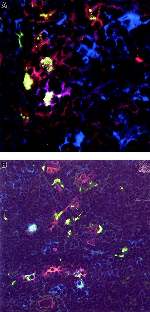 Fig. 3. Development of immature and mature DCs after intrathymic injection of CD34+ cells in mice. / Immunohistochemistry and confocal microscopy were performed 6 weeks after intrathymic injection of CFSE-labeled sorted CD34+CD38− fetal liver cells (A) and 4 weeks after the injection of MACS-purified CD34+ fetal liver cells (B) using CD123-PE and unconjugated CD83 mAbs. CFSE-labeled cells show green dots. CD123-PE–positive cells are red (visualized by rabbit anti-PE and Cy3-conjugated goat antirabbit) and CD83+ cells, visualized by goat antimouse biotin, and streptavidin-Cy5 cells are blue. CFSE-labeled cells that express CD123 alone (green dotted red cells), CD83 alone (green dotted blue cells), and CD123 and CD83 (green dotted purple cells) are visible. Isotype controls were negative. Original magnification × 800 (A) and × 400 (B).