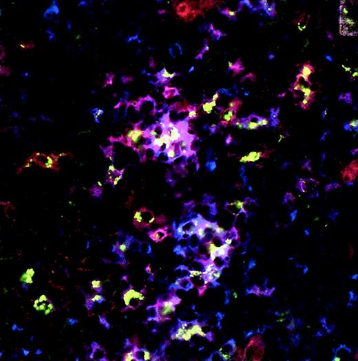 Fig. 4. Development of immature and mature lymphoid-derived DCs (DC2) after intrathymic injection of CD34+ cells in RAG2−/− γc−/−mice with a human thymus transplant. / Immunohistochemistry and confocal microscopy were performed 6 weeks after intrathymic injection of CFSE-labeled sorted CD34+CD38− fetal liver cells using CD123-PE and unconjugated CD11c mAbs. CFSE-labeled cells show green dots. CD123-PE–positive cells are red (visualized by rabbit anti-PE and Cy3-conjugated goat antirabbit), and CD11c+ cells visualized by goat antimouse biotin and streptavidin-Cy5 are blue. CFSE-labeled cells that express CD123 alone (green dotted red cells), CD11c alone (green dotted blue cells), and CD123 and CD11c (green dotted purple cells) are visible. Isotype controls were negative. Original magnification × 400.