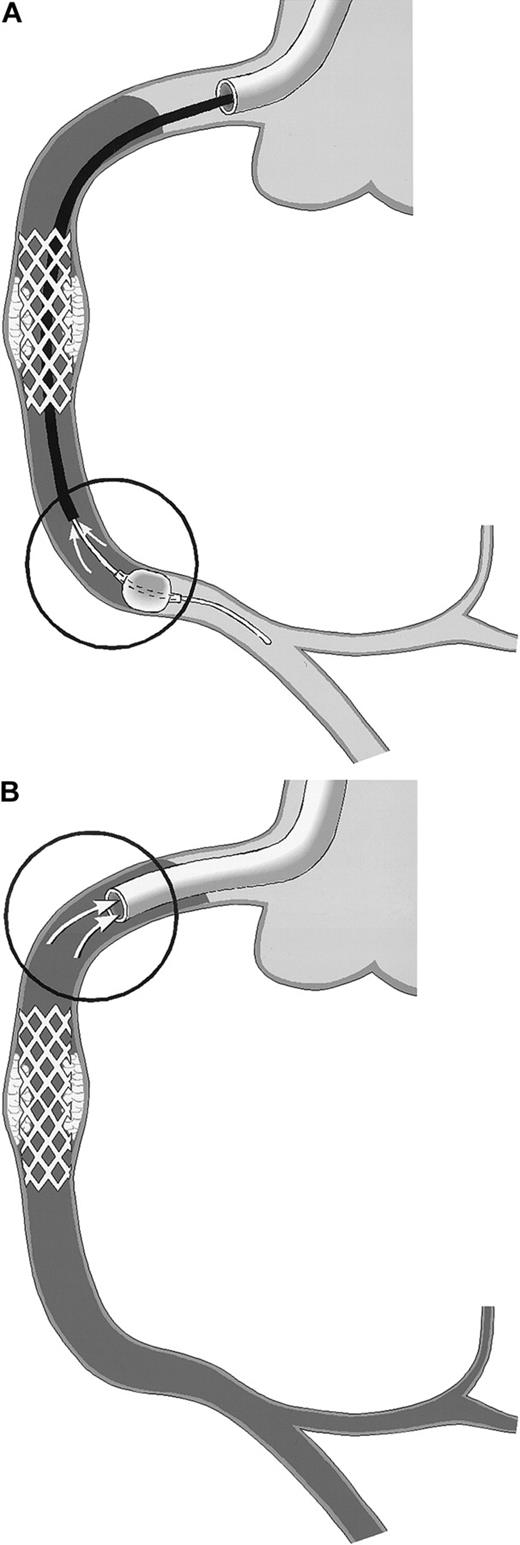 Fig. 1. Schematic drawing of coronary blood sampling. / The right coronary artery (RCA) is shown. Arrows within the circles point to the exact site of blood drawing. Stasis of the blood column is indicated by the use of gray. (A) PercuSurge distal protection device. Blood is aspirated from the tip of the export catheter, while the catheter is slowly withdrawn proximally. The harvested blood is passed over a filter. TF activity of the material on the filter is measured. (B) NR in the course of percutaneous transluminal coronary angioplasty (PTCA). Blood is aspirated from the static blood column at the tip of the guiding catheter, which is deeply intubated into the proximal vessel segment.