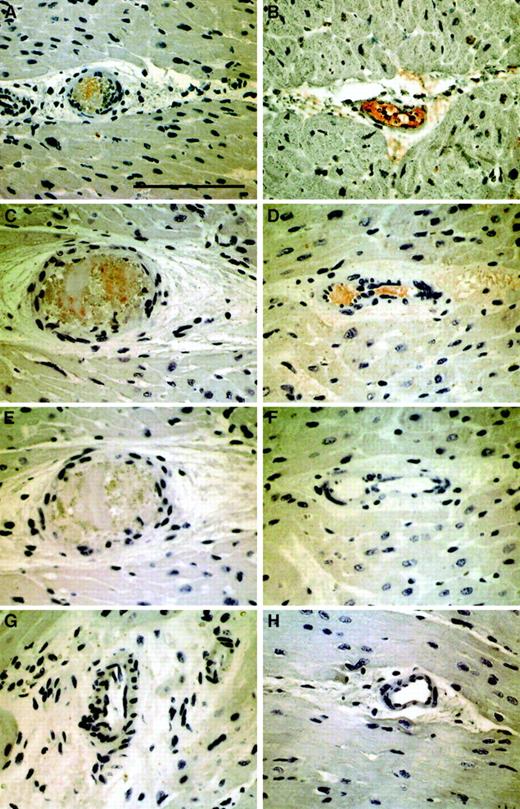 Fig. 4. Immunohistochemical detection of TF and fibrin in parallel sections of 2 representative myocardial specimens from experimentally induced NR. / Panels A, C, and E demonstrate arteriolar obstruction by atherosclerotic carotid plaque material and adjacent thrombus in a pig injected with carotid scraping (AM1). Panels B, D, and F show arteriolar thrombosis in pig TF2. Red immunoreactivity indicates positive staining with anti-TF (panels A,B) or antifibrin antibodies (panels C,D). Panels E and F represent negative controls stained with isotype antibodies. For comparison, panels G and H depict myocardial vessels from the same animals in uninjected territories stained with antifibrin antibodies. All panels were photographed at the original magnification × 400. The scale bar represents 100 μm.