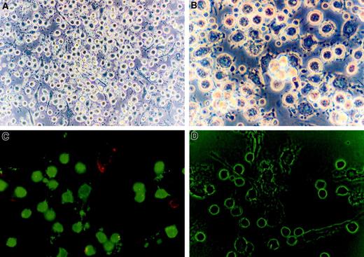 Fig. 2. CTCL cells are morphologically small CD3 + lymphocytes clustered around large granular class II + cells with dendritic appendages. / (A) Phase contrast microscopy (× 400) of cultured CTCL cells demonstrates that they have the morphology of small round lymphocytes. (B) The APCs were morphologically large granular cells with multiple dendritic extensions. (C) Immunofluorescent microscopy reveals that the CTCL cells are CD3+ (FITC, green) lymphocytes and the APCs express class II MHC molecules (phycoerythrin, red). (D) Phase contrast microscopy of the same field demonstrates the small round lymphocytes in direct contact with the membrane of large cells with multiple dendritic appendages. Original magnification × 400.