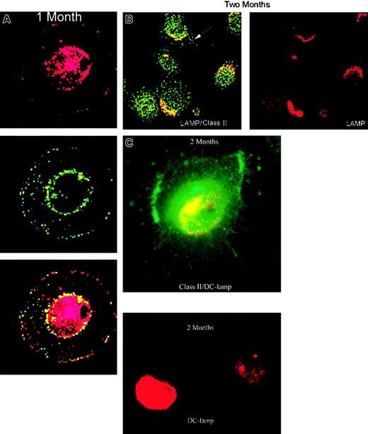 Fig. 5. Confocal microscopic evaluation of DCs from 1- and 2-month cultures. / (A) DCs were purified from 1-month cultures by CD2-bead depletion of CTCL cells. The DCs were stained for cytoplasmic expression of the lysosomal marker LAMP (red) and class II MHC (green). The 2 images were merged to reveal colocalization of lysosomal compartments containing class II MHC (yellow). (B) DCs purified from 2- month cultures demonstrate class II colocalization (yellow) with LAMP (red) in lysosomal compartments and migration of class II molecules (green) to dendritic extensions of the cell membrane (arrow). (C) Fluorescent microscopic observation demonstrates cytoplasmic DC-LAMP staining (red) and membrane class II staining (green) on dendritic appendages of mature DCs with starfish morphology at 2 months of culture. Original magnification × 630.
