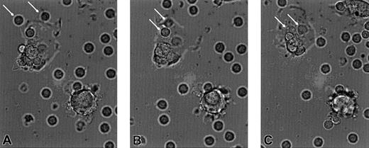 Fig. 8. Freeze-frame photomicrographs demonstrate that the APC are avidly phagocytic and ingest the apoptotic CTCL cells. / (A) CTCL cells (arrows) begin to adhere to the cell membrane of an APC, at 8 minutes after the addition of CD3 antibody. (B) The CTCL cells (arrows) become surrounded by a pseudopodial extension of the APC membrane, at 9 minutes. (C) The CTCL cells (arrows) have become fully internalized in the cytoplasm of the APC, at 10 minutes. Original magnification × 400.