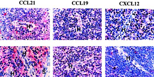 Fig. 4. Chemokine expression in CLL and normal lymph node tissue. / Formalin-fixed, paraffin-embedded material was stained by a triple-layer technique involving antichemokine antibody, a biotinylated second layer, and ExtrAvidin-alkaline phosphatase as a third layer. H indicates HEV; S, sinus. Note that HEVs contain weak staining for both CCL21 and CLL19. Some stromal cells, including peri-HEV fibroblasts, showed particularly marked staining for SLC. Control staining with the relevant nonspecific antibodies was completely negative. In the top panels (n = 5); bottom, (n = 4).