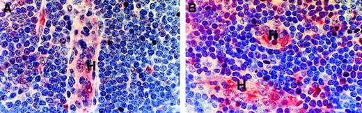 Fig. 7. VCAM-1 expression in CLL and normal lymph node tissue. / Formalin-fixed, paraffin-embedded material was stained by a triple-layer technique involving a mAb to VCAM-1, a biotinylated second layer, and ExtrAvidin-alkaline phosphatase as a third layer. H indicates HEV; (A), h=5; (B), n=4.