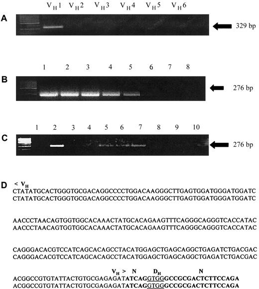 Fig. 1. Identification of clonal IgH rearrangement in diagnostic lymphoblasts and detection of leukemia/patient-specific IgH rearrangement in blood samples of archival newborn screening cards. / (A) Genomic DNA extracted from diagnostic lymphoblasts was amplified using a panel of 6 VH-segment family primers (VH 1-6) and a JH-segment consensus reverse primer (see “Patients, materials, and methods”). Lane 1 represents a patient/leukemia-specific clonal IgH gene rearrangement that was excised and sequenced. (B) Seminested PCR testing the specificity and sensitivity of the patient-specific primers designed across the DH-N-JH and N-DH-N segments based on the clonal IgH rearrangement identified in panel A. Lane 1 represents amplification of 100 ng of the patient's diagnostic genomic DNA; lanes 2 through 5 represent serial 1:10 dilutions of the patient's genomic DNA with genomic DNA extracted from peripheral blood lymphocytes of a healthy control. Lane 6 represents a PCR using control genomic DNA, and lanes 7 and 8 represent blank controls from the first and second rounds of the seminested PCRs, respectively. (C) PCR amplification of 2-mm punches obtained from the patient's newborn screening card blood sample using a seminested PCR with primers based on the IgH sequence identified in panel A. Lanes 2, 5, 6, and 7 represent punches in which the patient/leukemia-specific IgH rearrangement was amplified by seminested PCRs using a set of patient/leukemia-specific primers as described in “Patients, materials and methods.” Lane 8 represents a PCR using a punch from an artificial control newborn card and lanes 9 and 10 represent blank controls. (D) DNA sequence identifying identical IgH genomic sequences from the patient's newborn screening card blood samples amplified in panel C (lower sequence) and from lymphoblasts obtained at diagnosis (upper sequence).