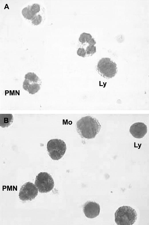 Fig. 1. Immunocytochemical staining of blood PMNs. / (A) Negative control; no staining was observed with a control immunoglobulin. (B) Intracellular red staining was observed in PMNs with specific monoclonal anti-HGF antibodies; smears were examined by light microscopy at ×800; (Ly indicates lymphocytes; Mo, monocytes).