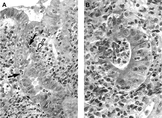 Fig. 1. Pathologic aspect of digestive GVHD. / (A) Duodenal biopsy with apoptotic epithelial cells (white arrow), some of them in close contact with intra-epithelial mononuclear cells (black arrows), and dense infiltrate in the lamina propria, composed mononuclear and polynuclear cells. Hematoxylin-eosin, × 250. (B) Higher magnification of damaged glandular epithelium “exploding crypt” in the lamina propria. Hematoxylin-eosin, × 400.