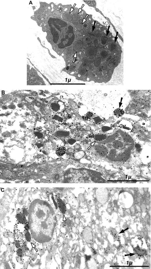 Fig. 2. Ultrastructural study of tissue eosinophils on digestive biopsy with histologic GVHD. / (A) Eosinophils showing moderate signs of activation. Most cytoplasmic granules are altered and have characteristic crystal-shaped central cores that either disappear or are of diminished intensity (white arrows) compared with the few remaining normal central cores (black arrows). However, the cytoplasm is not disintegrated, and there are no cytoplasmic granules in the extracellular space. Epon embedding; bar = 1 μm. (B) Eosinophil showing signs of important in situ activation; the cytoplasm is partially disintegrated, and eosinophil granules are found in the intercellular space. Staining with an antibody directed against eosinophil peroxidase shows gold particles in the matrix of eosinophil granules, whether intracytoplasmic (white arrow) or extracellular (black arrow). Lowicryl HM20 embedding, indirect immunogold staining with an antibody directed against eosinophil peroxidase; bar = 1 μm. (C) Activated eosinophil synthesizing IL-5. Immunogold labeling with an antibody directed against IL-5 shows gold particles in the matrix of cytoplasmic granules (white arrows) in the extracellular space (black arrows) and in damaged extracellular granules. Lowicryl HM20 embedding, indirect immunogold staining with an antibody directed against IL-5; bar = 1 μm.